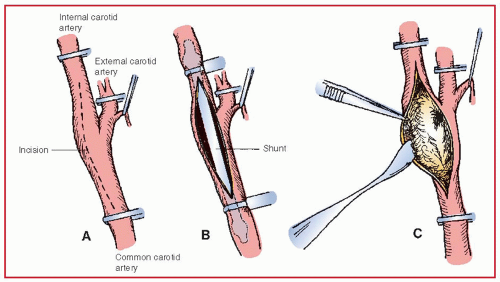 Pdf anesthetic considerations for carotid endarterectomy procedure surgery